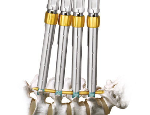 REVOLVE® – Sistema de fixação suplementar percutâneo